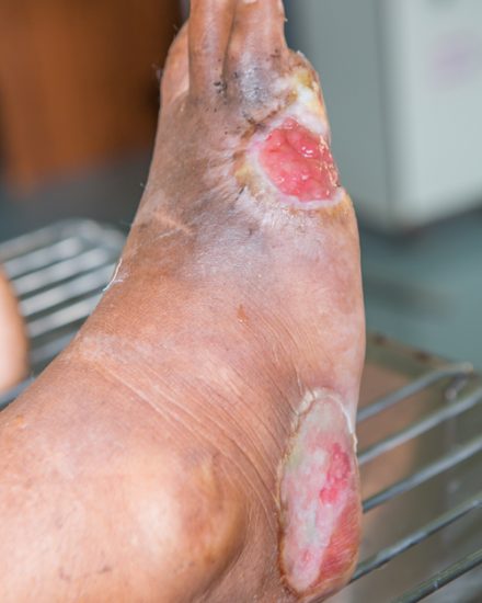 Foot ulcers from diabetes , selective focus.